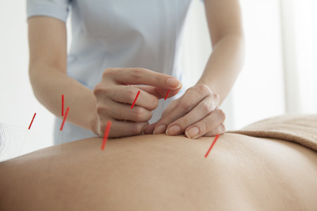 acupuncture